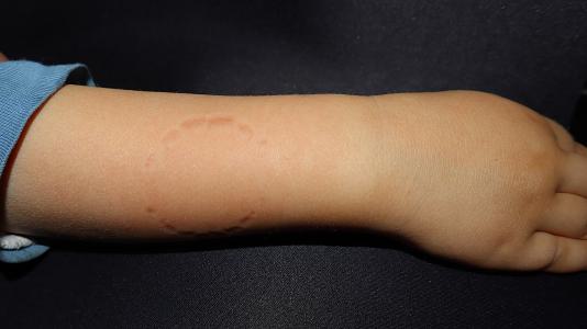 Wenn Kinderbisse nicht nur weh tun – sondern gefährlich werden können